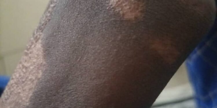 Saudi Kakooza's amputated hand