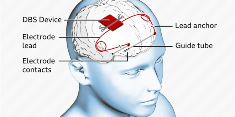The device stimulates parts of the brain