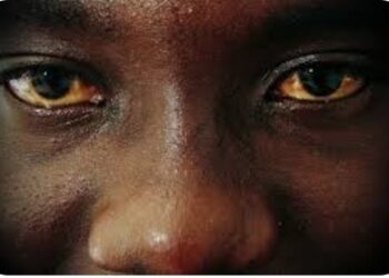 Unexpected Risks: How You Could Get Syphilis In Your Eyes