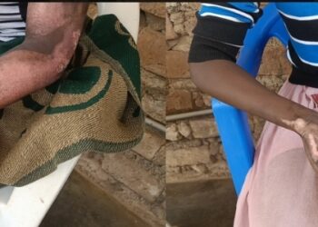 Auma and Akello sustained fire injuries