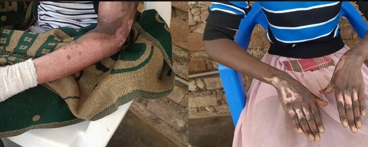 Auma and Akello sustained fire injuries