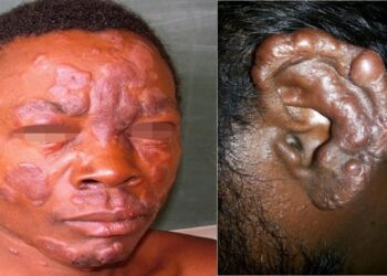 Leprosy Is Curable, but Stigma Still Shapes the Global Health Response